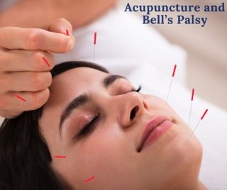 Acupuncture and Bell's Palsy