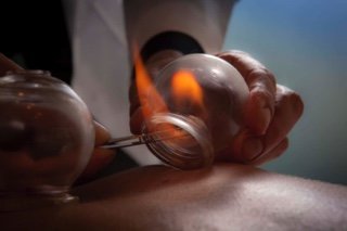 What is Cupping Therapy?